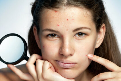 Maschere viso fai da te con acne e impurità