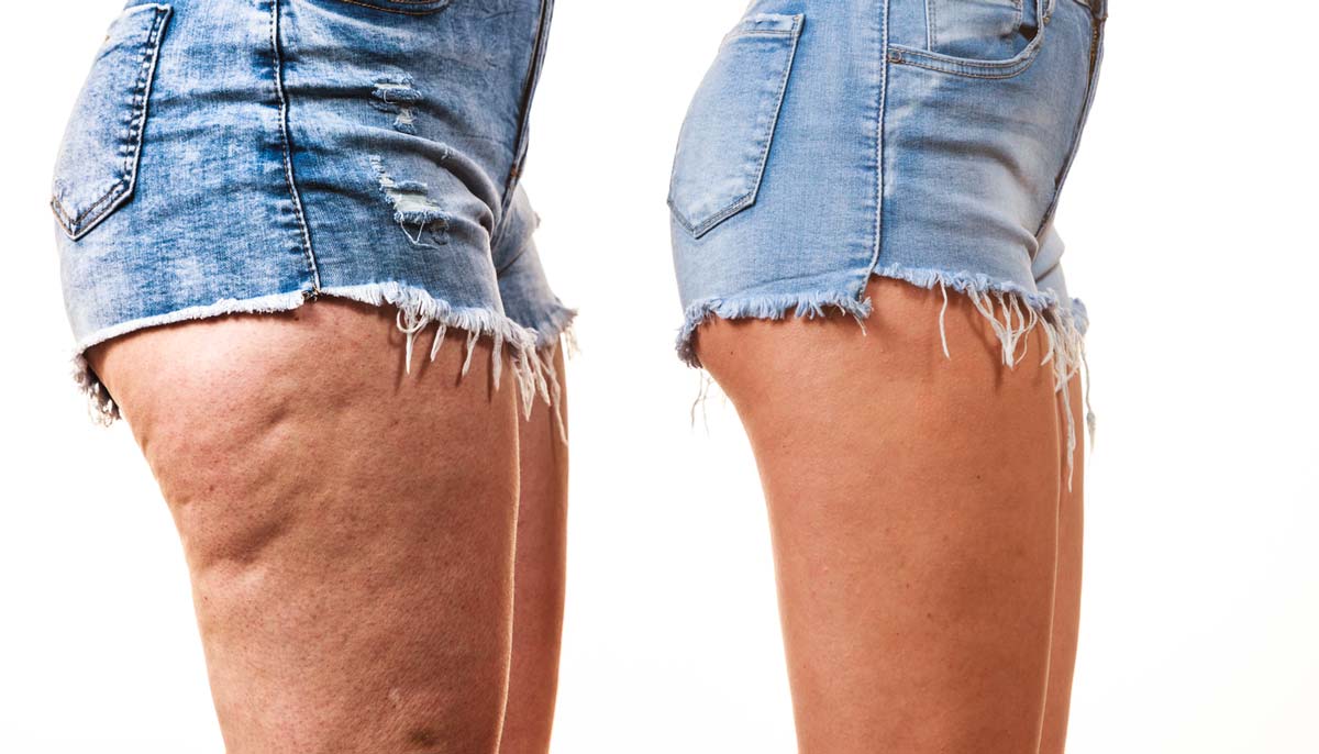 rimedi per la cellulite